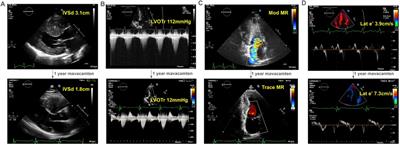 One-year real-world experience with mavacamten and its physiologic effects on obstructive hypertrophic cardiomyopathy